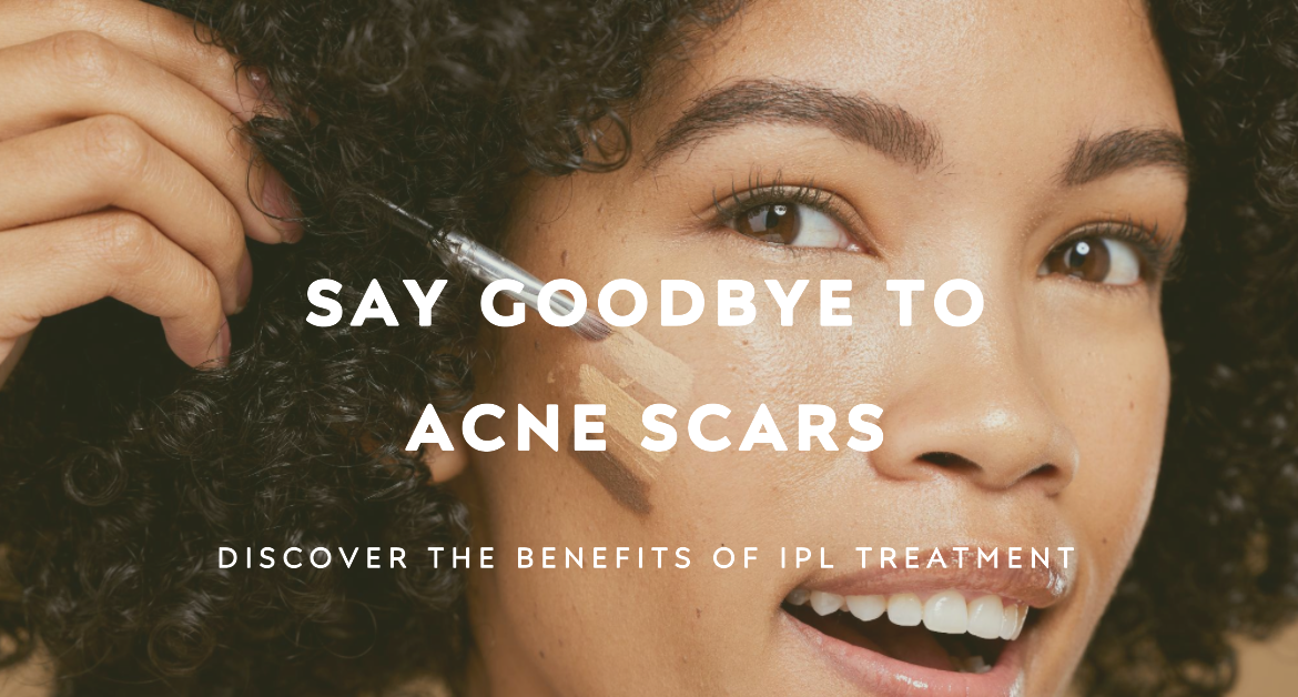 IPL Treatment for Acne Scars-Say Goodbye to Acne Scars