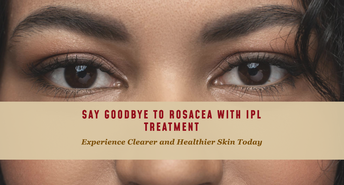 IPL for Rosacea A Game-Changer in Skin Care